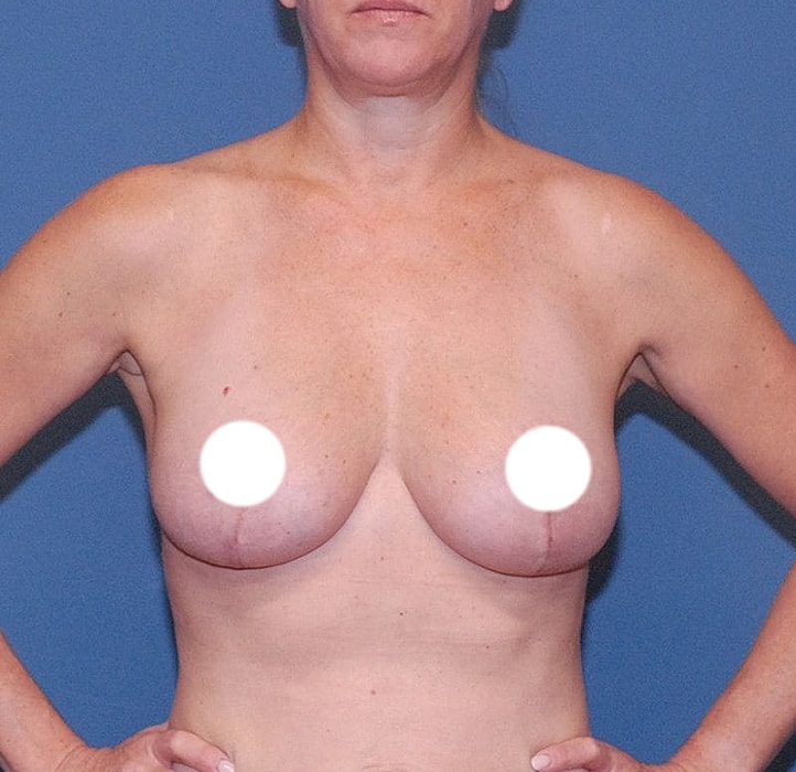 Post-surgery breast appearance with scars and tape.