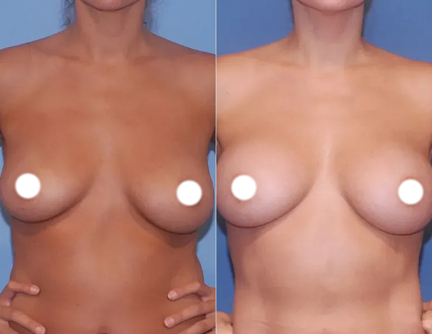 Before and after breast enhancement comparison image.