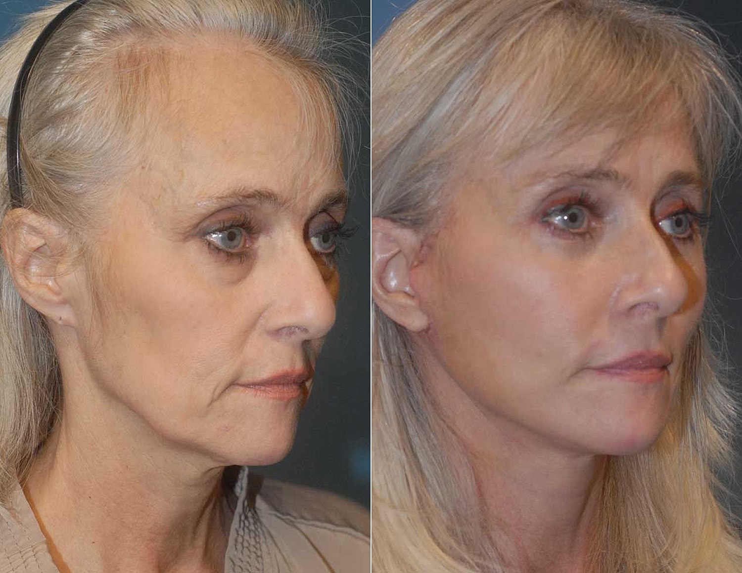 Before and after facial rejuvenation treatment comparison.