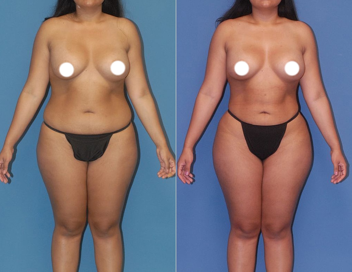 Body comparison on blue background, front view.