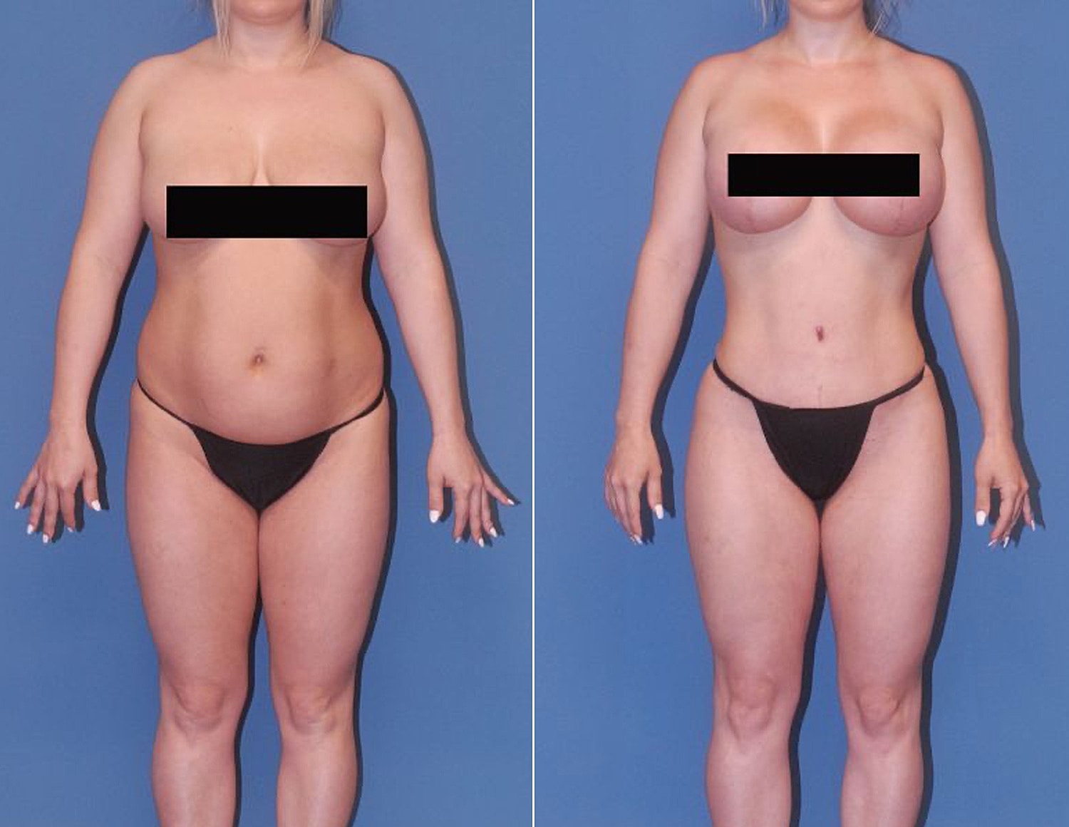 Before and after body transformation comparison.