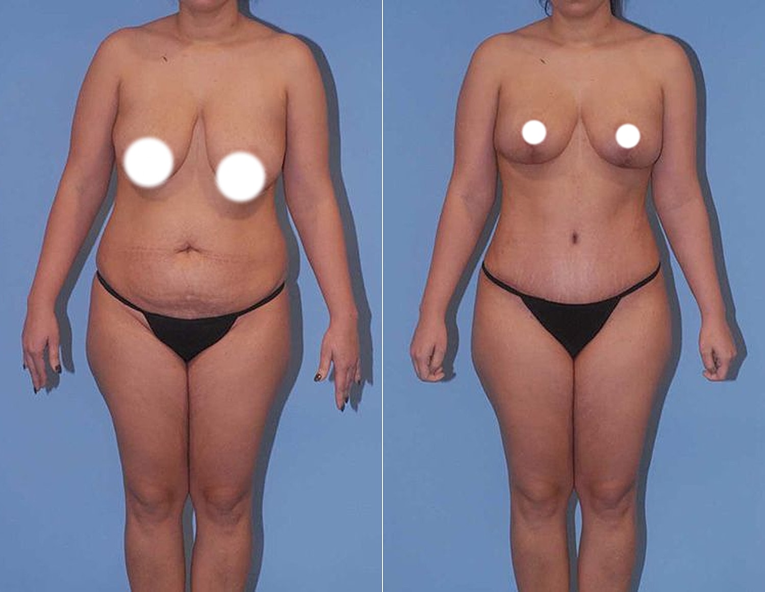 Before and after body transformation photography.