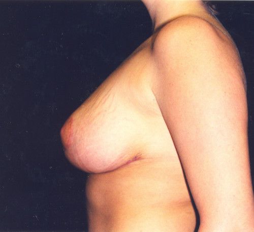 Breast Reduction And Lift Before & After