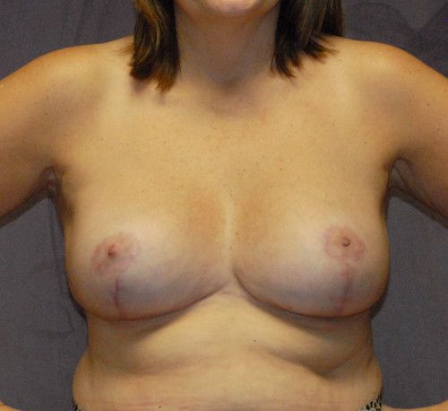 Breast Reduction And Lift Before & After