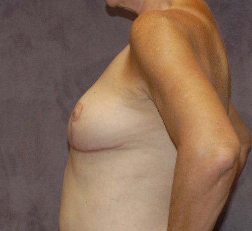 Breast Reduction And Lift Before & After