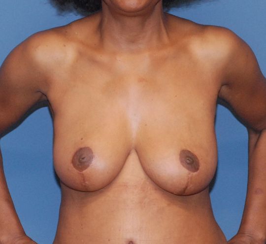 Breast Reduction And Lift Before & After