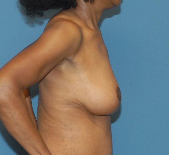 Breast Reduction And Lift Before & After