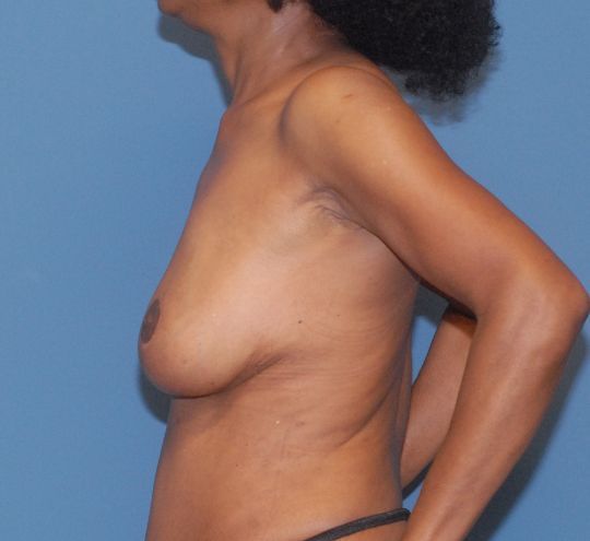 Breast Reduction And Lift Before & After