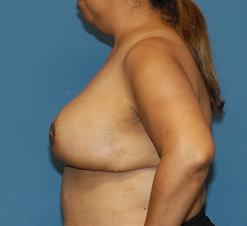 Breast Reduction And Lift Before & After
