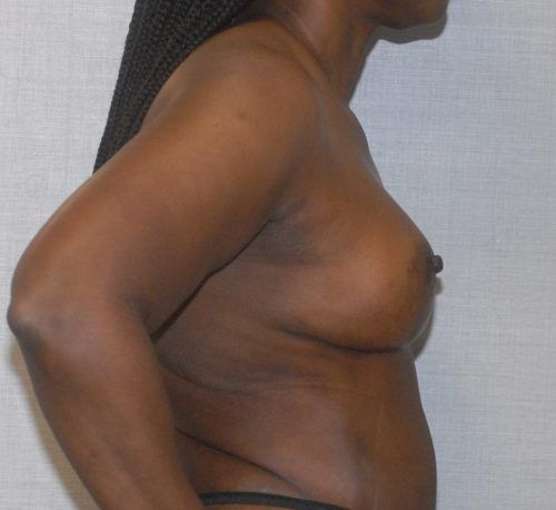 Breast Reduction And Lift Before & After