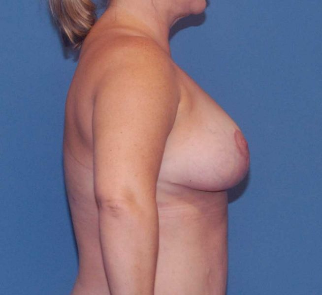 Breast Reduction And Lift Before & After