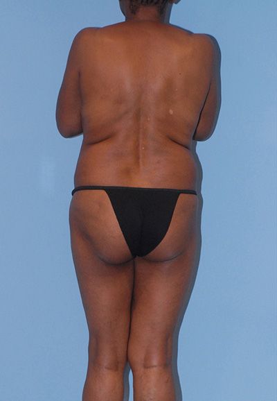 Breast Reduction And Lift Before & After