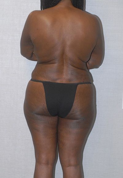 Breast Reduction And Lift Before & After