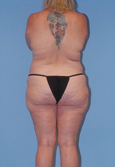 Breast Reduction And Lift Before & After