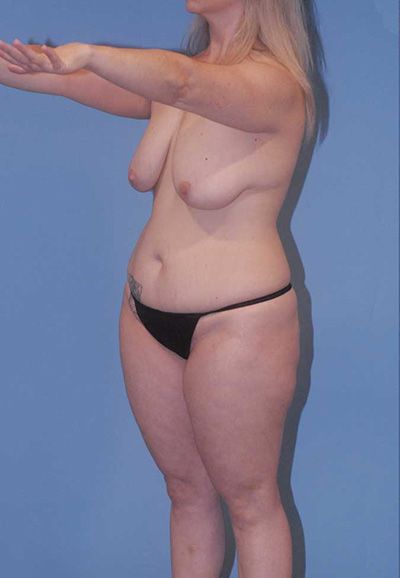 Breast Reduction And Lift Before & After