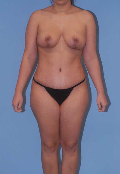 Breast Reduction And Lift Before & After