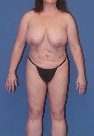 Breast Reduction And Lift Before & After