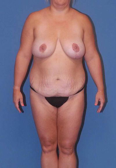 Breast Reduction And Lift Before & After