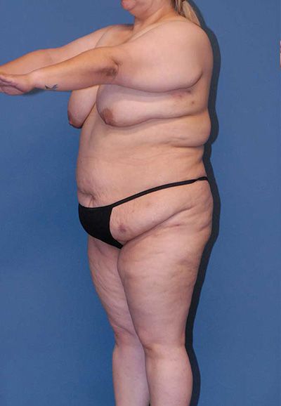 Breast Reduction And Lift Before & After