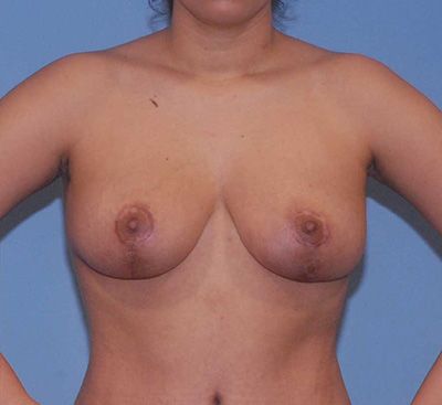 Breast Reduction And Lift Before & After