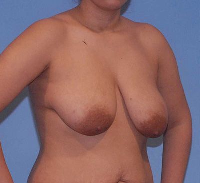 Breast Reduction And Lift Before & After