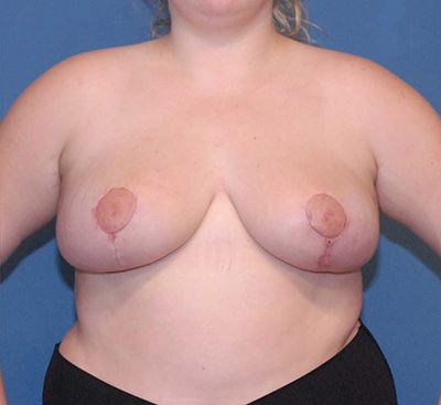 Breast Reduction And Lift Before & After