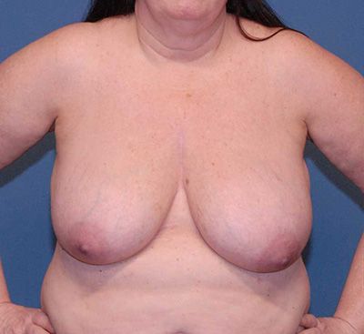 Breast Reduction And Lift Before & After