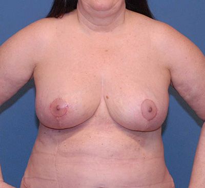 Breast Reduction And Lift Before & After