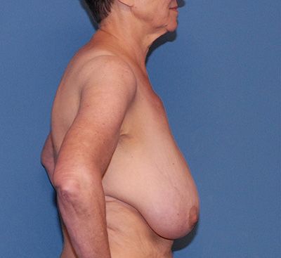 Breast Reduction And Lift Before & After
