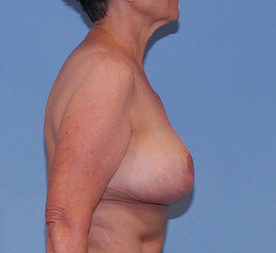 Breast Reduction And Lift Before & After