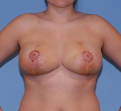 Breast Reduction And Lift Before & After