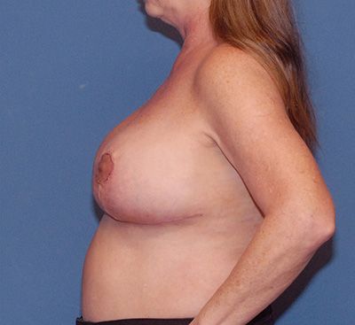 Breast Reduction And Lift Before & After