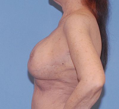 Breast Reduction And Lift Before & After