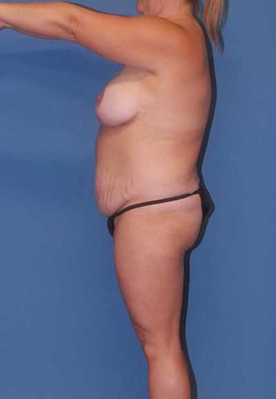 Breast Reduction And Lift Before & After