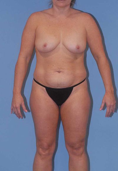 Breast Reduction And Lift Before & After