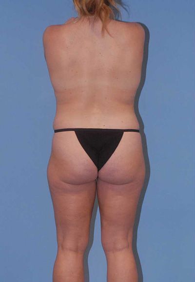 Breast Reduction And Lift Before & After