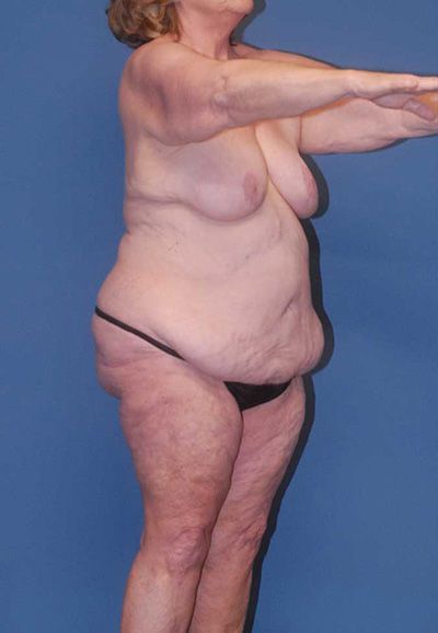 Breast Reduction And Lift Before & After