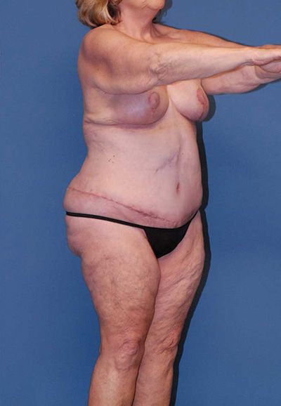 Breast Reduction And Lift Before & After