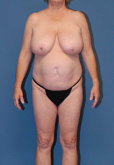 Breast Reduction And Lift Before & After