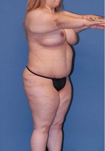 Breast Reduction And Lift Before & After