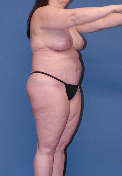 Breast Reduction And Lift Before & After