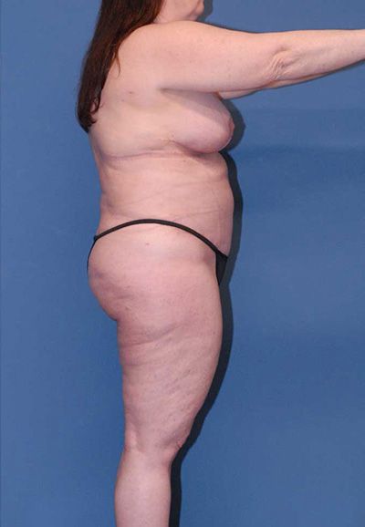 Breast Reduction And Lift Before & After