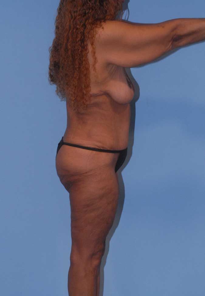 Abdominoplasty Before & After