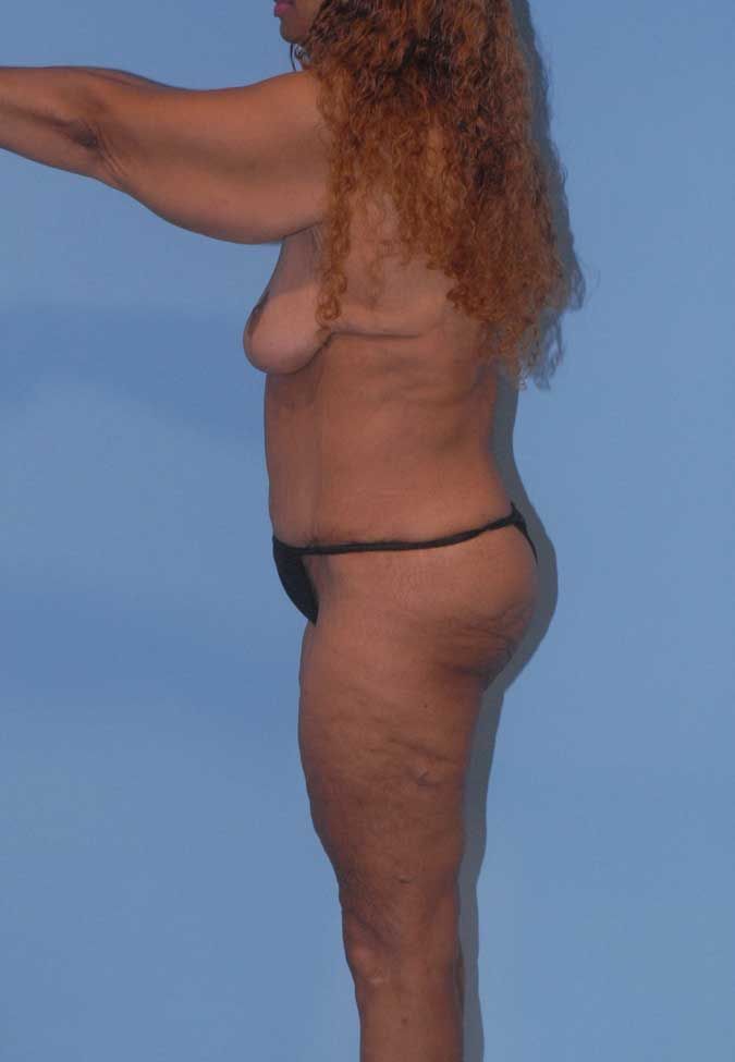 Abdominoplasty Before & After