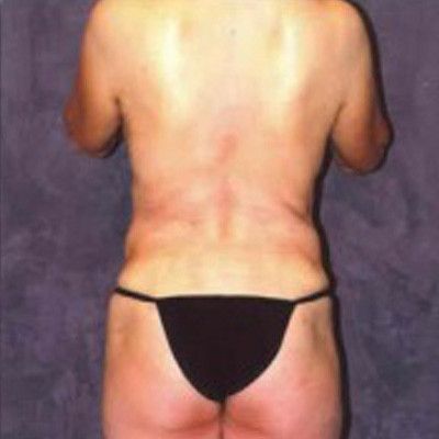 Abdominoplasty Before & After