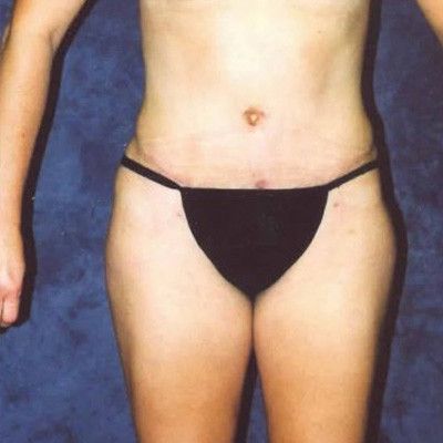 Abdominoplasty Before & After