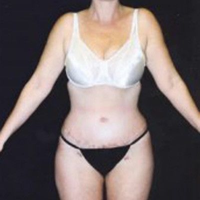 Abdominoplasty Before & After