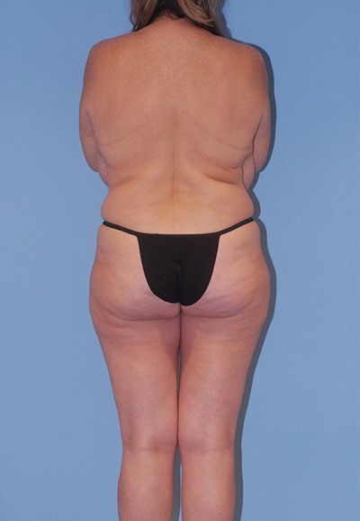 Abdominoplasty Before & After