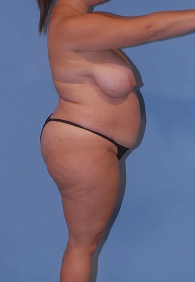 Abdominoplasty Before & After