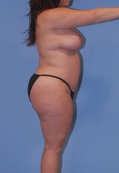 Abdominoplasty Before & After